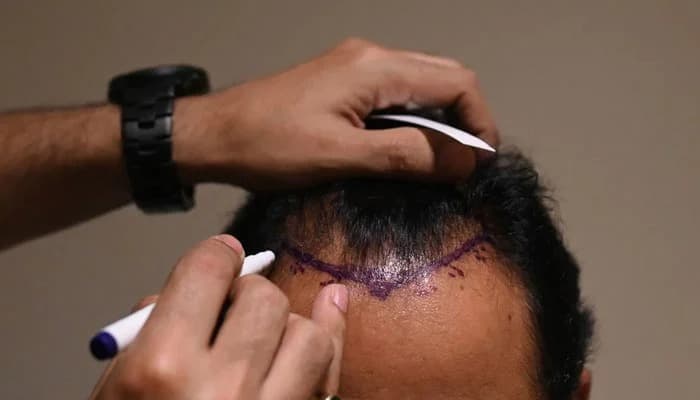 Best Hair Transplant UK Clinics – Why We’re Rated #1
