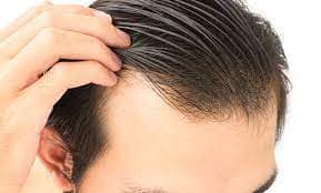 Hair Transplant Turkey: Achieve Permanent Hair Restoration