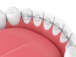 Ceramic Braces Care Tips for a Healthy and Beautiful Smile